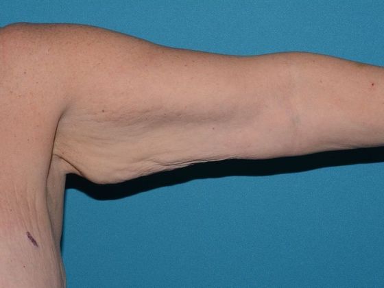 Arm Lift: Case 1 - Indianapolis - Before