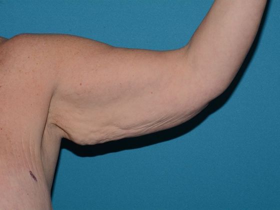 Arm Lift: Case 1 - Indianapolis - Before