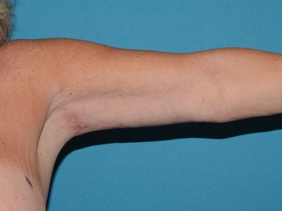 Arm Lift: Case 1 - Indianapolis - After