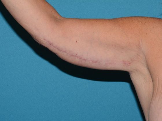 Arm Lift: Case 1 - Indianapolis - After