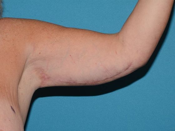 Arm Lift: Case 1 - Indianapolis - After