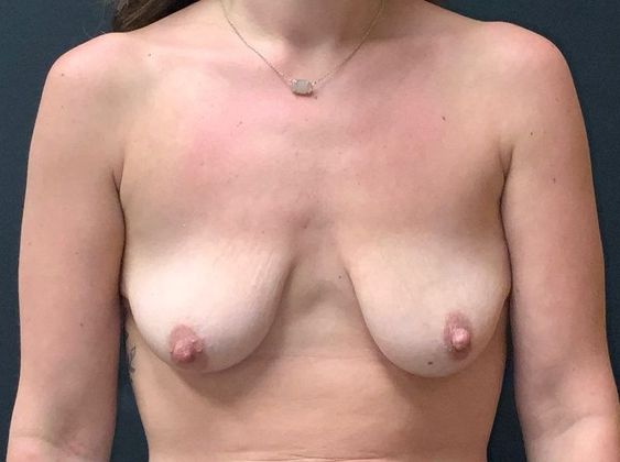 Breast Augmentation Case 25 - Before