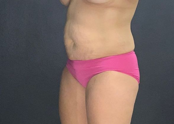 Abdominoplasty: Case 21 - Before