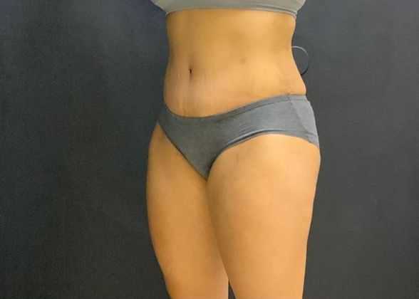 Abdominoplasty: Case 21 - After