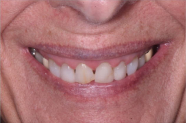 Cosmetic Crowns Case 6 - Before