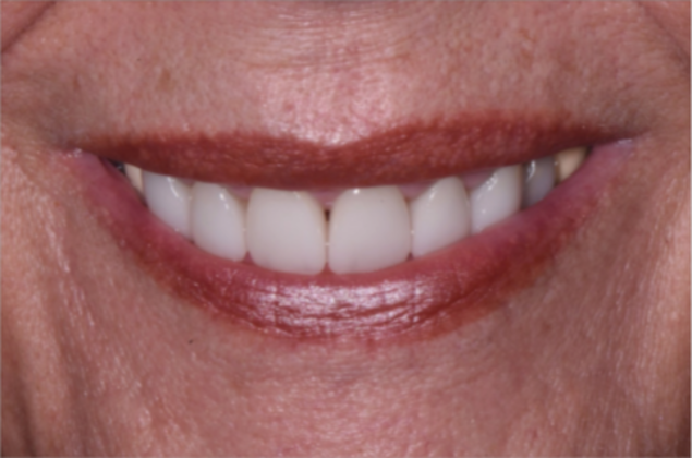 Cosmetic Crowns Case 6 - After