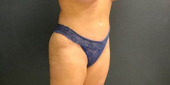 Abdominoplasty Case 22 - After