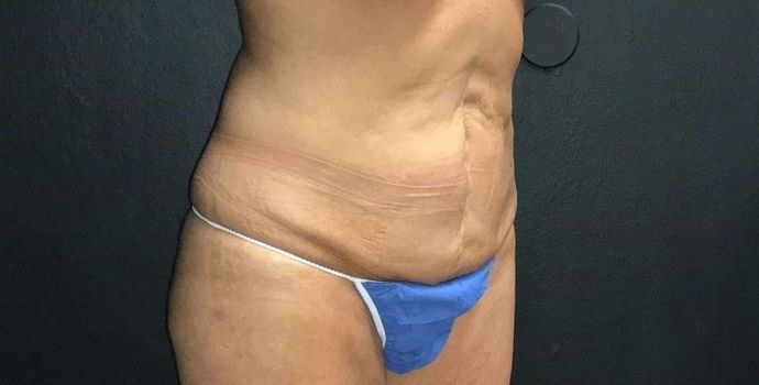 Abdominoplasty Case 22 - Before