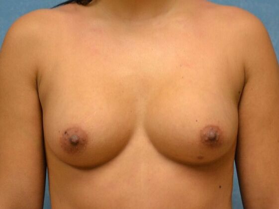 Breast Augmentation: Case 1367- Toledo, OH - Before