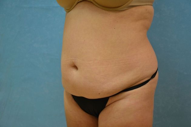 Tummy Tuck: Case 1808- Oak Harbor, OH - Before
