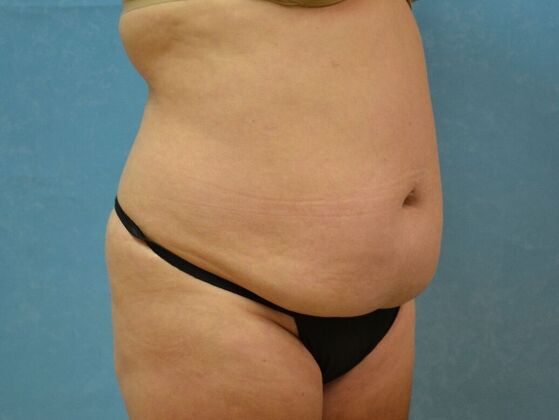 Tummy Tuck: Case 1808- Oak Harbor, OH - Before