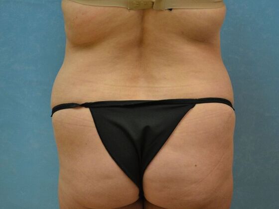 Tummy Tuck: Case 1808- Oak Harbor, OH - Before