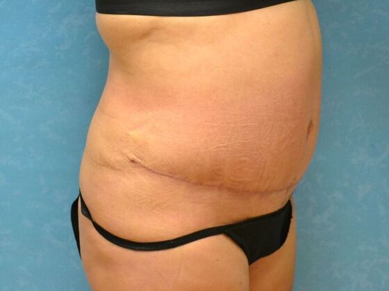 Tummy Tuck: Case 1808- Oak Harbor, OH - After