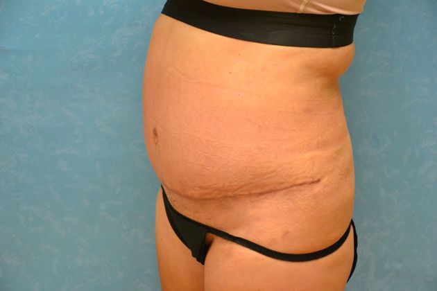 Tummy Tuck: Case 1808- Oak Harbor, OH - After