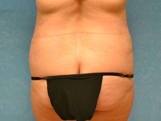 Tummy Tuck: Case 1808- Oak Harbor, OH - After