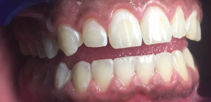 Teeth Whitening Case 1 - After