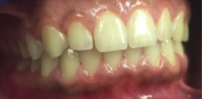 Teeth Whitening Case 1 - Before