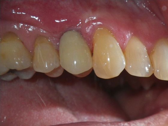 Dental Implants: Case 2 - Before