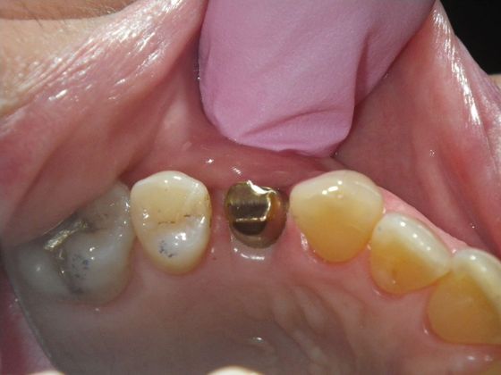 Dental Implants: Case 2 - Before