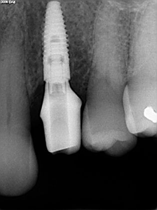 Dental Implants: Case 2 - Before