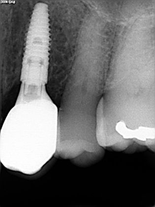 Dental Implants: Case 2 - After