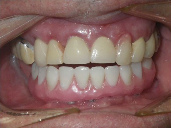 Dental Implants: Case 3 - Before