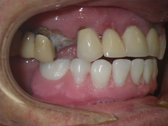 Dental Implants: Case 3 - Before