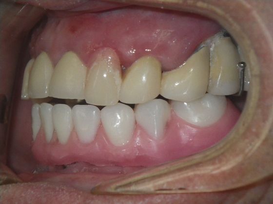 Dental Implants: Case 3 - Before