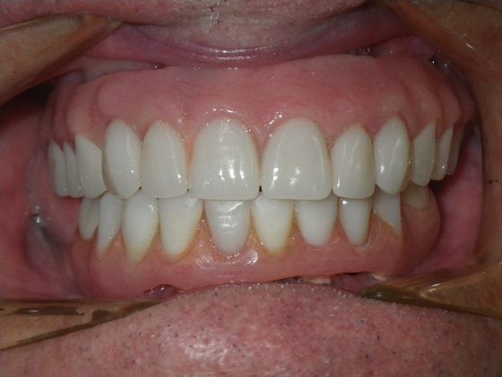 Dental Implants: Case 3 - After