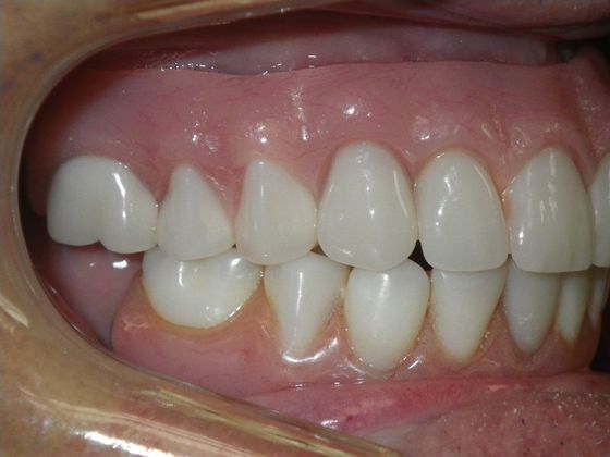Dental Implants: Case 3 - After