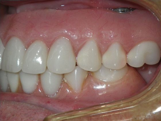 Dental Implants: Case 3 - After