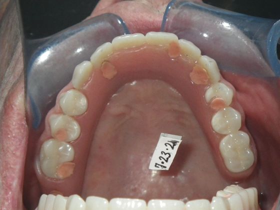Dental Implants: Case 3 - Before