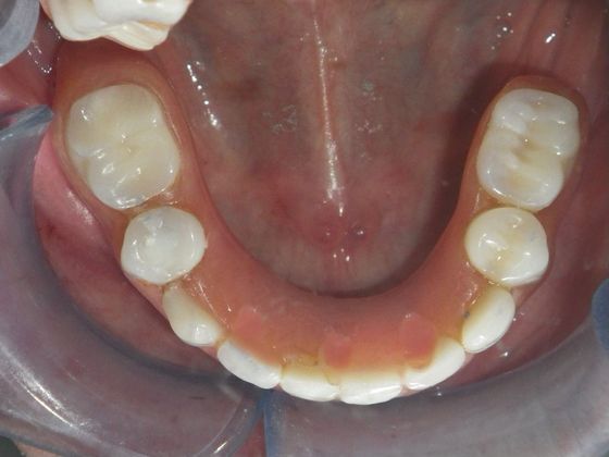 Dental Implants: Case 3 - After