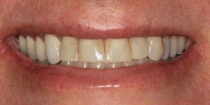 Full Mouth Reconstruction: Case 21 - Before