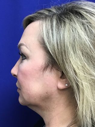 Facial Facelift / Necklift: Case 23 (23157) - Before