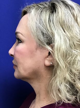 Facial Facelift / Necklift: Case 23 (23157) - After