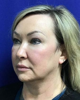 Facial Facelift / Necklift: Case 23 (23157) - Before