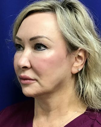 Facial Facelift / Necklift: Case 23 (23157) - After
