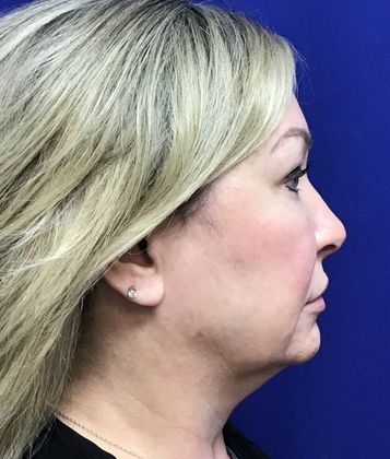 Facial Facelift / Necklift: Case 23 (23157) - Before