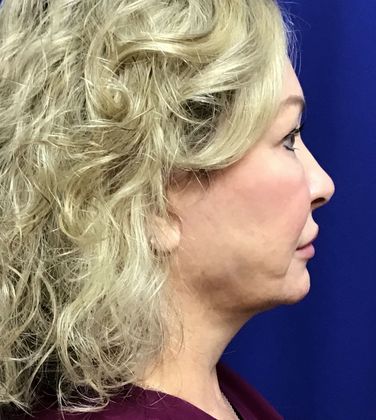 Facial Facelift / Necklift: Case 23 (23157) - After