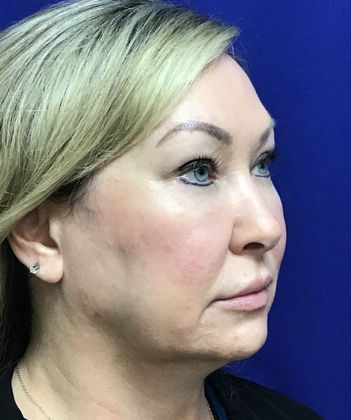 Facial Facelift / Necklift: Case 23 (23157) - Before