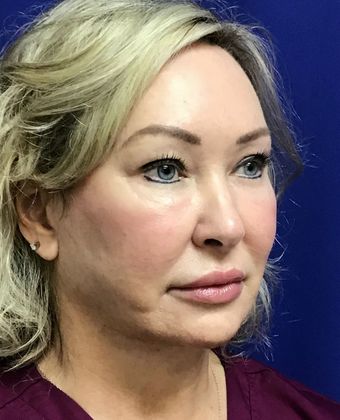 Facial Facelift / Necklift: Case 23 (23157) - After