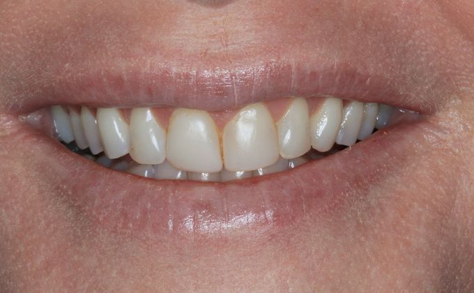 Full Mouth Reconstruction: Case 22 - Before