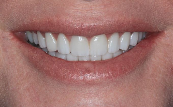 Full Mouth Reconstruction: Case 22 - After