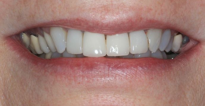 Full Mouth Reconstruction: Case 23 - Before