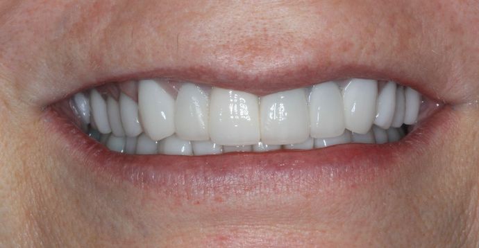 Full Mouth Reconstruction: Case 23 - After