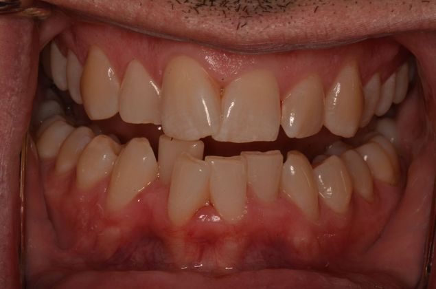 Invisalign: Case 17 - Before invisalign