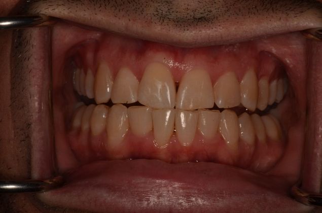 Invisalign: Case 17 - After invisalign (orthodontics)