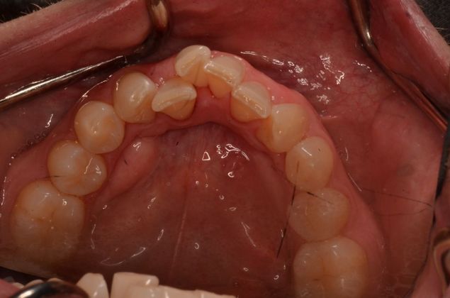 Invisalign: Case 17 - Lower teeth before invisalgin