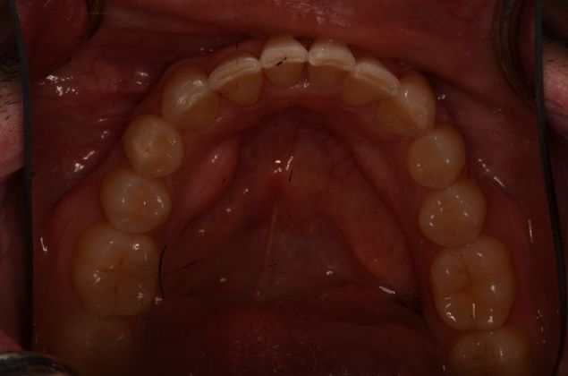 Invisalign: Case 17 - Lower teeth after invisalgin